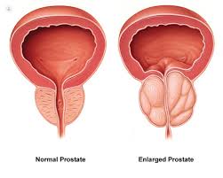 cáncer de próstata en la vejez