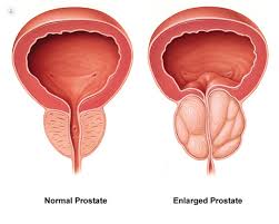 prostatita stagnanta la 25 de ani