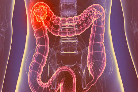 Cáncer de colon
