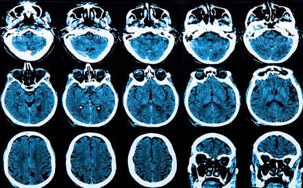 Escaner cerebral para detectar alzheimer